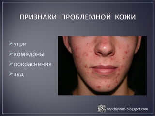 topchiyirina.blogspot.com
угри
комедоны
покраснения
зуд
 
