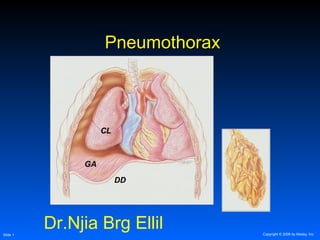 Copyright © 2006 by Mosby, Inc.Slide 1
PneumothoraxPneumothorax
GA
DD
CL
Dr.Njia Brg Ellil
 