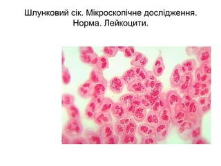 Шлунковий сік. Мікроскопічне дослідження.
Норма. Лейкоцити.
 