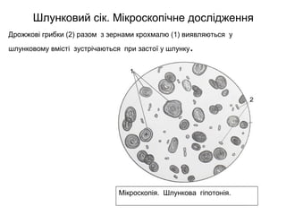 Шлунковий сік. Мікроскопічне дослідження
Дрожжові грибки (2) разом з зернами крохмалю (1) виявляються у
шлунковому вмісті зустрічаються при застої у шлунку.
ЗернаЗерна
крохмалюкрохмалю
дрожжові грибкидрожжові грибки
у шлунковому мвстішлунковому мвсті
Мікроскопія. Шлункова гіпотонія.
 