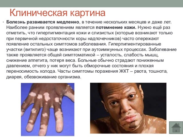 Болезнь Аддисона