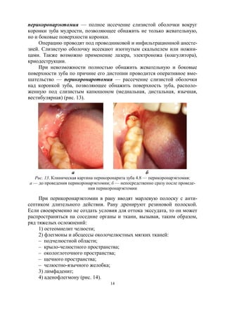 14
перикоронарэктомия — полное иссечение слизистой оболочки вокруг
коронки зуба мудрости, позволяющее обнажить не только жевательную,
но и боковые поверхности коронки.
Операцию проводят под проводниковой и инфильтрационной анесте-
зией. Слизистую оболочку иссекают изогнутым скальпелем или ножни-
цами. Также возможно применение лазера, электроножа (коагулятора),
криодеструкции.
При невозможности полностью обнажить жевательную и боковые
поверхности зуба по причине его дистопии проводится оперативное вме-
шательство — перикоронаротомия — рассечение слизистой оболочки
над коронкой зуба, позволяющее обнажить поверхность зуба, располо-
женную под слизистым капюшоном (медиальная, дистальная, язычная,
вестибулярная) (рис. 13).
а б
Рис. 13. Клиническая картина перикоронарита зуба 4.8 — перикоронарэктомия:
а — до проведения перикоронарэктомии; б — непосредственно сразу после проведе-
ния перикоронарэктомии
При перикоронарэктомии в рану вводят марлевую полоску с анти-
септиком длительного действия. Рану дренируют резиновой полоской.
Если своевременно не создать условия для оттока экссудата, то он может
распространяться на соседние органы и ткани, вызывая, таким образом,
ряд тяжелых осложнений:
1) остеомиелит челюсти;
2) флегмоны и абсцессы околочелюстных мягких тканей:
‒ подчелюстной области;
‒ крыло-челюстного пространства;
‒ окологлоточного пространства;
‒ щечного пространства;
‒ челюстно-язычного желобка;
3) лимфаденит;
4) аденофлегмону (рис. 14).
 
