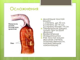 Осложнения
 Дилатация толстой
кишки:
1 степень до 10 см
2 степень 10-14 см
3 степень более 14 см
 Перфорация (редко,
только при острой
форме)
 Кровотечение
 Псевдополипоз
 Рак толстой кишки
(высокая степень
злокачественности,
множественная
локализация)
 