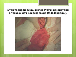 Этап трансформации илеостомы-резервуара
в тонкокишечный резервуар (М.П.Захараш).
 
