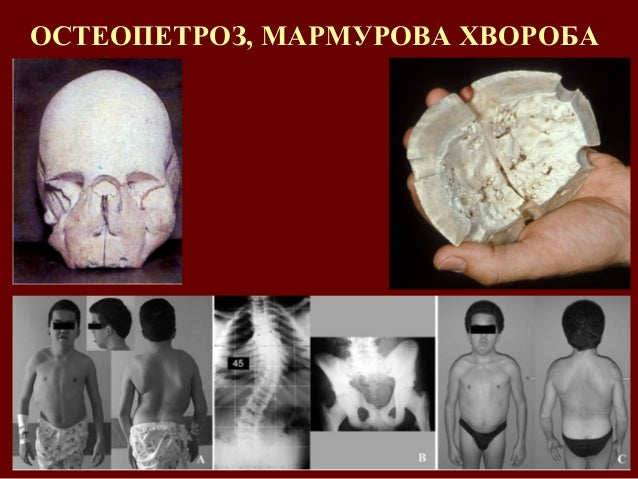 патофізіологія сполучної тканини