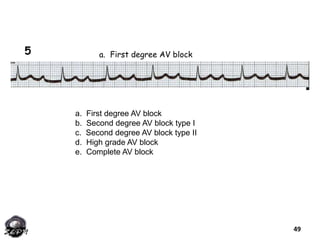 a. First degree AV block
b. Second degree AV block type I
c. Second degree AV block type II
d. High grade AV block
e. Comp...