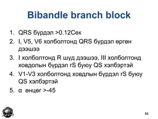 Bibandle branch block
1. QRS бүрдэл >0.12Сек
2. I, V5, V6 холболтонд QRS бүрдэл өргөн
дээшээ
3. I холболтонд R шүд дээшээ,...