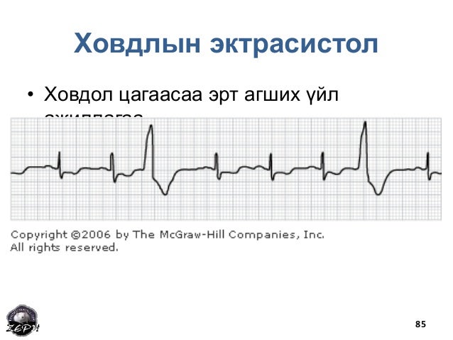 Зүрхний хэм алдагдал