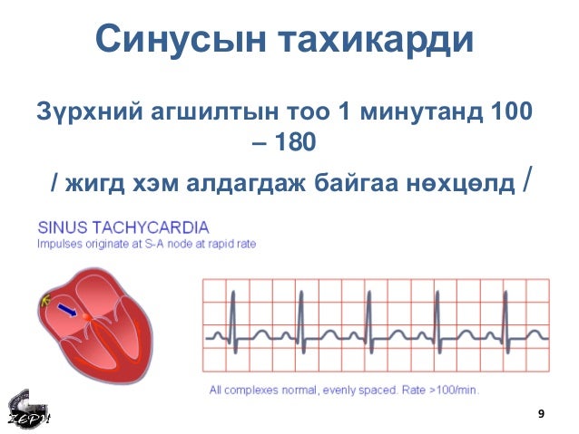 Зүрхний хэм алдагдал