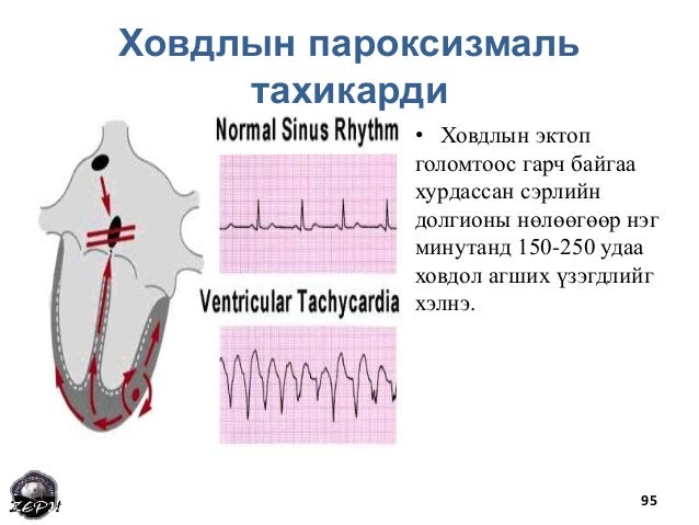 Зүрхний хэм алдагдал