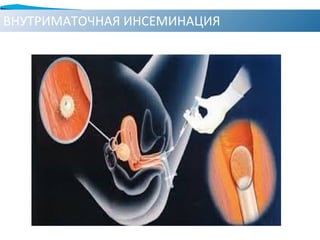 ВНУТРИМАТОЧНАЯ ИНСЕМИНАЦИЯ
 