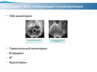 Программа ЭКО: стимуляция суперовуляции
• УЗИ-мониторинг
• Гормональный мониторинг
- Эстрадиол
- ЛГ
- Прогестерон
 