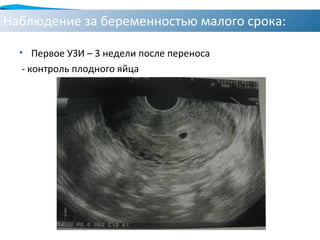 Наблюдение за беременностью малого срока:
• Первое УЗИ – 3 недели после переноса
- контроль плодного яйца
 