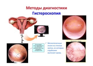 МетодыМетоды диагностикидиагностики
ГистероскопияГистероскопия
Мелкоточечные
очаги на стенках
матки, из которых
струйками
...