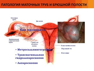 ПАТОЛОГИЯ МАТОЧНЫХ ТРУБ И БРЮШНОЙ ПОЛОСТИ
Как проверить
• Метросальпингография
• Трансвагинальная
гидролапароскопия
• Лапароскопия
 