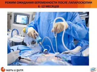 РЕЖИМ ОЖИДАНИЯ БЕРЕМЕННОСТИ ПОСЛЕ ЛАПАРОСКОПИИ
6 -12 МЕСЯЦЕВ
 
