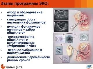 • отбор и обследование
пациентов
• стимуляция роста
нескольких фолликулов
• пункция фолликулов
яичников – забор
яйцеклеток
• оплодотворение
яйцеклеток и
культивирование
эмбрионов in vitro
• перенос эмбрионов в
полость матки
• диагностика беременности
ранних сроков
Этапы программы ЭКО:
 