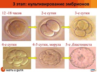 2-е сутки 3-е сутки
4-е сутки 4-5 сутки, морула 5-е ,бластоциста
12 -18 часов
3 этап: культивирование эмбрионов
 