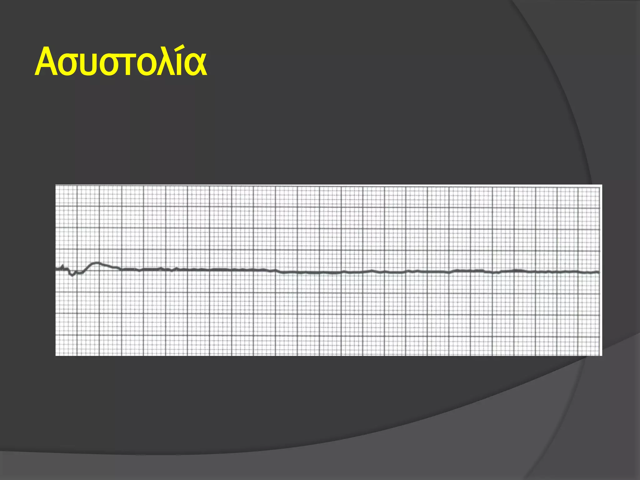 Ασυστολία
 