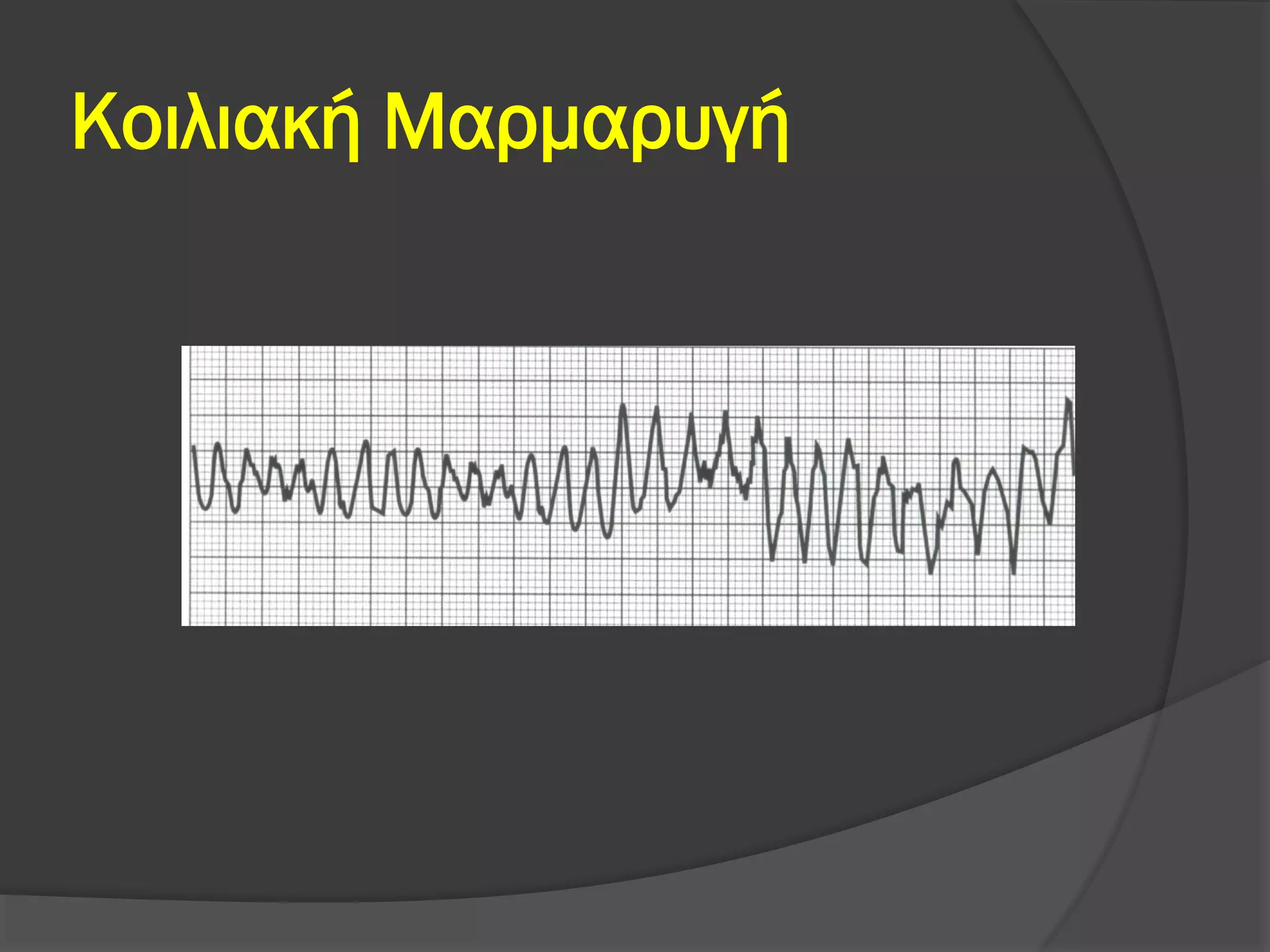 Κοιλιακή Μαρμαρυγή
 