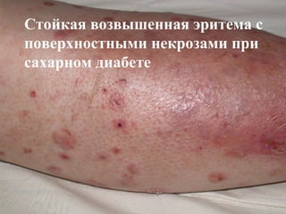 Стойкая возвышенная эритема с
поверхностными некрозами при
сахарном диабете
 