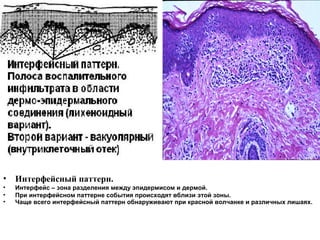 • Интерфейсный паттерн.
• Интерфейс – зона разделения между эпидермисом и дермой.
• При интерфейсном паттерне события происходят вблизи этой зоны.
• Чаще всего интерфейсный паттерн обнаруживают при красной волчанке и различных лишаях.
 