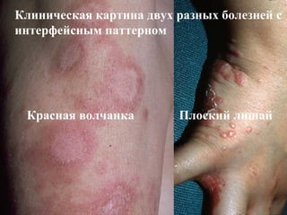 Клиническая картина двух разных болезней с
интерфейсным паттерном
Красная волчанка Плоский лишай
 
