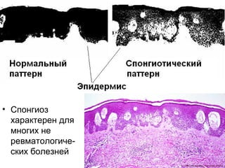• Спонгиоз
характерен для
многих не
ревматологиче-
ских болезней
 