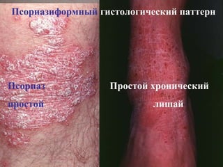 Псориазиформный гистологический паттерн
Псориаз Простой хронический
простой лишай
 