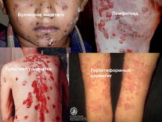 Простая пузырчатка Герпетиформный
дерматит
ПемфигоидБуллезное импетиго
 