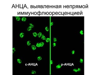 АНЦА, выявленная непрямой
иммунофлюоресценцией
с-АНЦА p-АНЦА
 