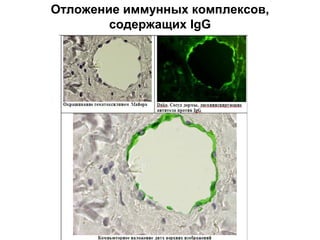 Отложение иммунных комплексов,
содержащих IgG
 