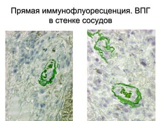 Прямая иммунофлуоресценция. ВПГПрямая иммунофлуоресценция. ВПГ
в стенке сосудовв стенке сосудов
 