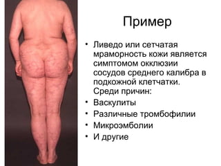 Пример
• Ливедо или сетчатая
мраморность кожи является
симптомом окклюзии
сосудов среднего калибра в
подкожной клетчатки.
Среди причин:
• Васкулиты
• Различные тромбофилии
• Микроэмболии
• И другие
 