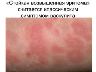 «Стойкая возвышенная эритема»
считается классическим
симптомом васкулита
 
