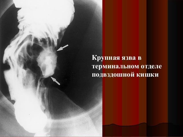 болезнь бехчета