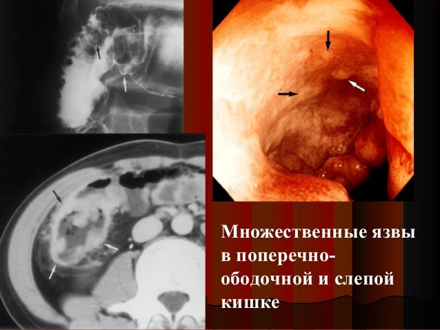 болезнь бехчета