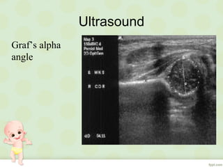 Ultrasound
Graf’s alpha
angle
 