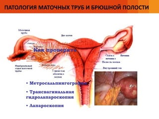 ПАТОЛОГИЯ МАТОЧНЫХ ТРУБ И БРЮШНОЙ ПОЛОСТИ
Как проверить
• Метросальпингография
• Трансвагинальная
гидролапароскопия
• Лапароскопия
 