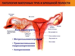 ПАТОЛОГИЯ МАТОЧНЫХ ТРУБ И БРЮШНОЙ ПОЛОСТИ
Как проверить
• Метросальпингография
• Трансвагинальная
гидролапароскопия
• Лапароскопия
 