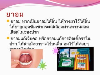 ยาอม
ยาอม หากเป็นยาอมใต้ลิ้น ให้วางยาไว้ใต้ลิ้น
ให้ยาถูกดูดซึมเข้ากระแสเลือดผ่านทางหลอด
เลือดในช่องปาก
ยาอมแก้เจ็บคอ หรือยาอมแก้การติดเชื้อราใน
ปาก ให้นำาเม็ดยาวางไว้บนลิ้น อมไว้ให้ค่อยๆ
ละลายในปาก
 