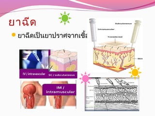 ยาฉีด
ยาฉีดเป็นยาปราศจากเชื้อ
 