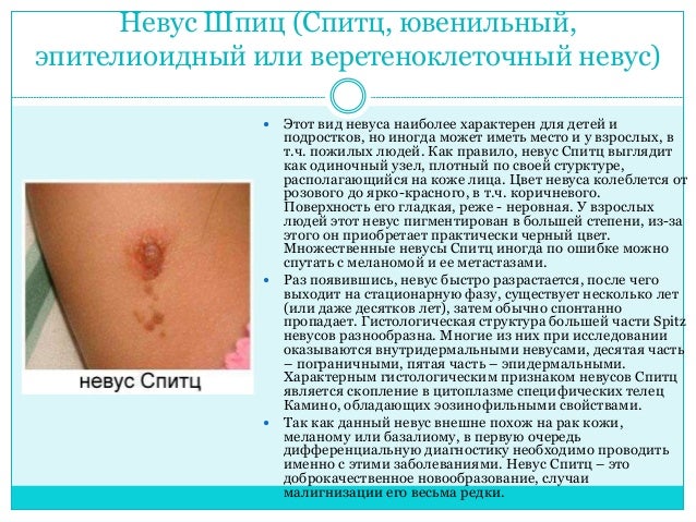 Невусы.