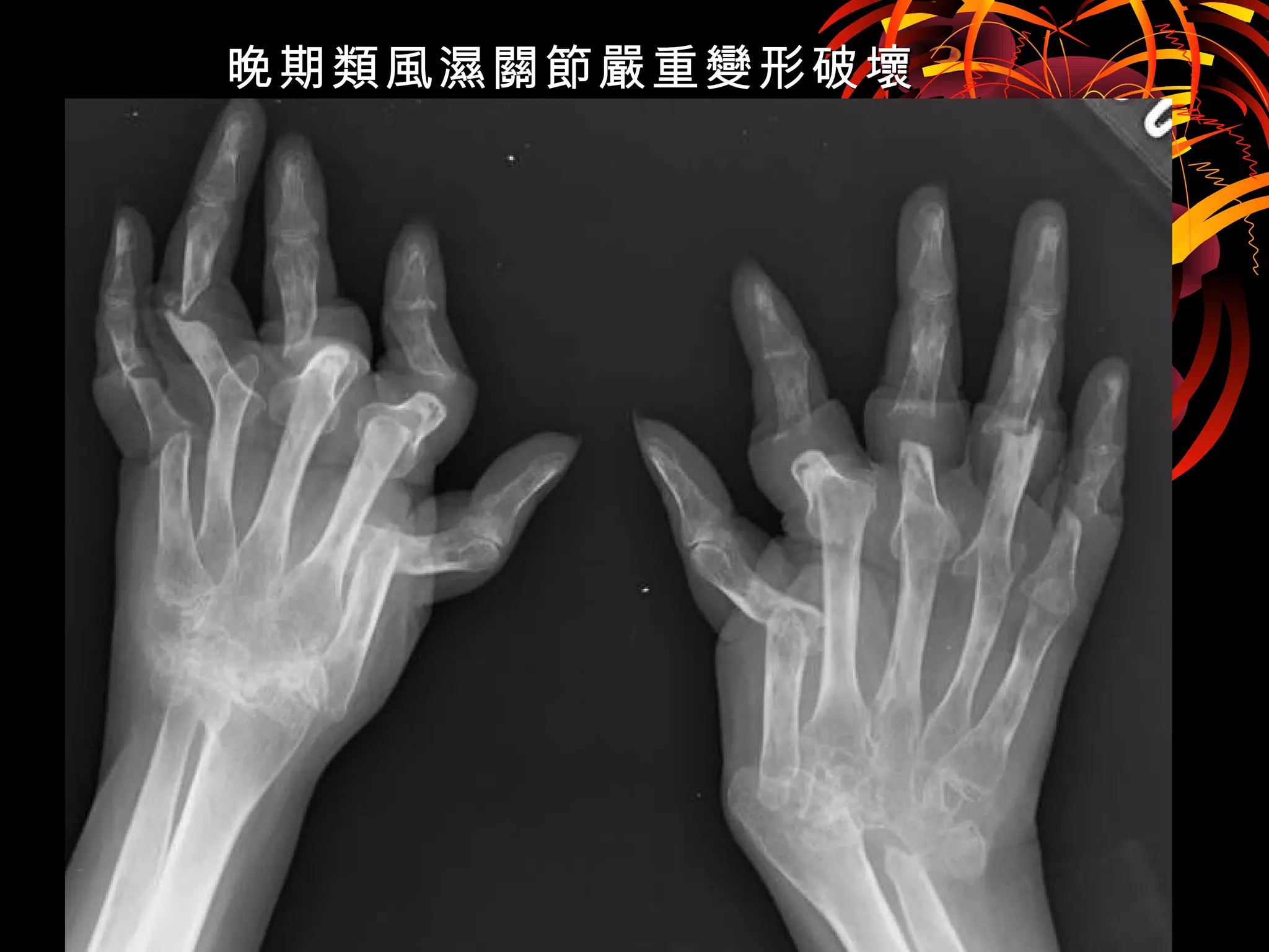 晚期類風濕關節嚴重變形破壞晚期類風濕關節嚴重變形破壞
 