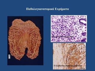 Παθολογοανατομικά Ευρήματα
Τ1a invasive carcinoma
E-Cadherine immunoexpression
 
