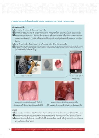 4 คู่มือการรักษาโรคติดเชื้อแบคทีเรียด้วยยาปฏิชีวนะที่โรงพยาบาลส่งเสริมสุขภาพตำ�บล  .  โครงการควบคุมและป้องกันการดื้อยาต้านจุลชีพในประเทศไทย
2. คอหอย/ต่อมทอนซิลอักเสบเฉียบพลัน (Acute Pharyngitis, J02, Acute Tonsillitis, J03)
ลักษณะทางคลินิก
þ	อาการเด่น คือ เจ็บคอ มักมีอาการมากเวลากลืน
þ	อาการที่อาจมีร่วมด้วย คือ ไข้ อาจมีอาการของหวัด (คัดจมูก มีน�้ำมูก จาม) ปวดเมื่อยตัว อ่อนเพลีย ไอ
þ	ตรวจคอหอยพบคอหอยแดง ต่อมทอนซิลแดง ควรตรวจด้วยไฟฉายแสงขาวเพื่อเห็นความแดงของคอหอย
และต่อมทอนซิลตามจริง อาจมีฝ้าหรือตุ่มหนองที่ต่อมทอนซิล อาจมีจุดเลือดออกที่เพดานปาก อาจมีแผล
ในปาก
þ	อาจคล�ำพบต่อมน�้ำเหลืองบริเวณล�ำคอ (ไม่ใช่ต่อมน�้ำเหลืองใต้คาง) โตและกดเจ็บ
þ	อาจให้ผู้ป่วยเห็นลักษณะคอหอย/ต่อมทอนซิลของตนเองเทียบกับรูปคอหอย/ต่อมทอนซิลอักเสบที่เกิดจาก
ไวรัสและแบคทีเรีย ดังแสดงในรูป
สาเหตุ
þ	ส่วนมาก (มากกว่าร้อยละ 80) เกิดจากไวรัส ส่วนน้อยเกิดจากแบคทีเรีย (โดยเฉพาะ สเตร็ปโตคอคคัส กลุ่มเอ)
þ	คอหอย/ต่อมทอนซิลอักเสบจากไวรัสมักมีลักษณะแดงเล็กน้อย ต่อมทอนซิลอาจโตได้ อาจมีแผลในปาก
þ	คอหอย/ต่อมทอนซิลอักเสบจากแบคทีเรียมักมีลักษณะแดงจัด อาจพบฝ้าหรือตุ่มหนองที่ต่อมทอนซิล อาจ
พบจุดเลือดออกที่เพดานปาก
ตรวจด้วยกระจก ภาพถ่ายด้วยโทรศัพท์
ชนิดพกพา
คอหอย/ต่อมทอนซิลอักเสบจากไวรัสมักมี
ลักษณะแดงเล็กน้อย อาจพบต่อมทอนซิลโตได้
คอหอย/ต่อมทอนซิลอักเสบจากแบคทีเรีย
มีลักษณะแดงจัด อาจพบฝ้าหรือตุ่มหนองที่ต่อมทอนซิล
 