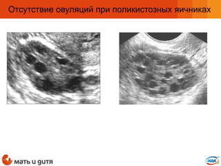 Отсутствие овуляций при поликистозных яичниках
 