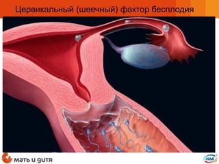 Цервикальный (шеечный) фактор бесплодия
 