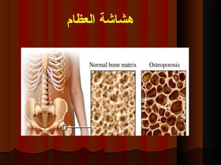 ‫ابلعظام‬ ‫هشاشة‬
 