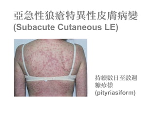 亞急性狼瘡特異性皮膚病變
(Subacute Cutaneous LE)
持續數日至數週
糠疹樣
(pityriasiform)
 